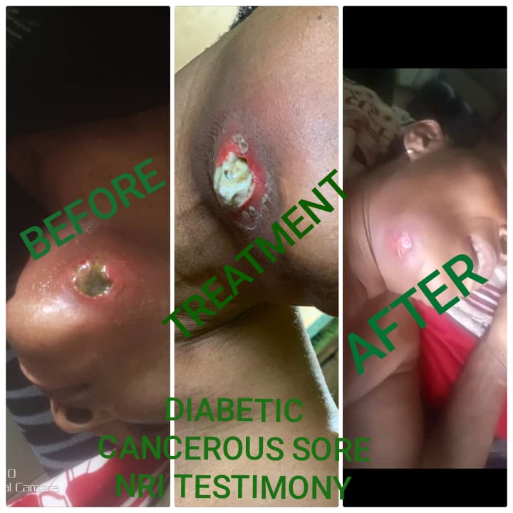 Cancerous-Sore-Healing-Testy-1.jpeg